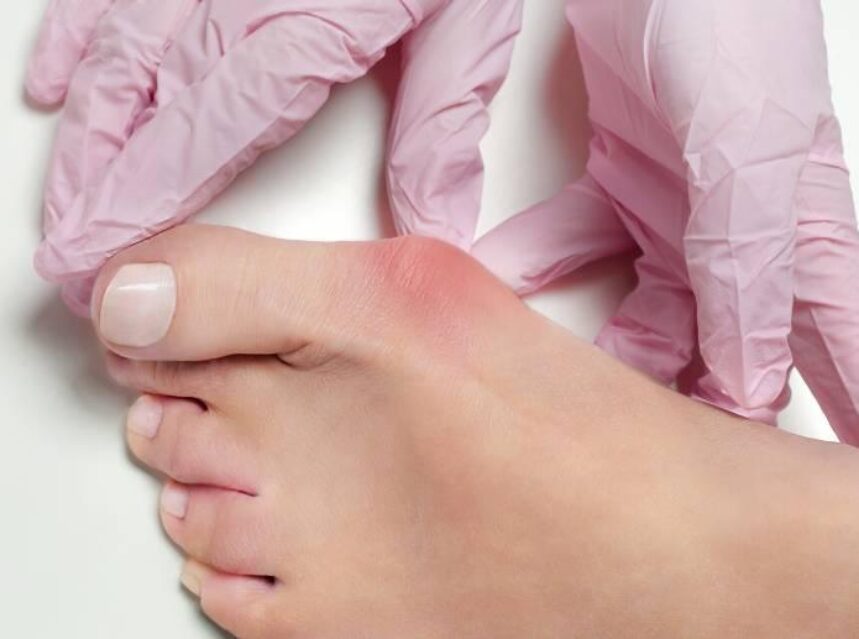 Un pie con un juanete es tocado por un par de manos con guantes quirúrgicos.