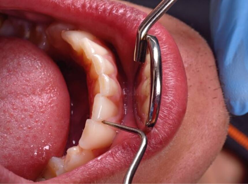 Parte inferior de la dentadura de una persona está siendo revisada por un profesional de la salud bucal.