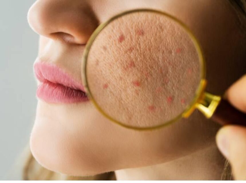 Rostro de mujer es revisado con lupa, sobresale acne.