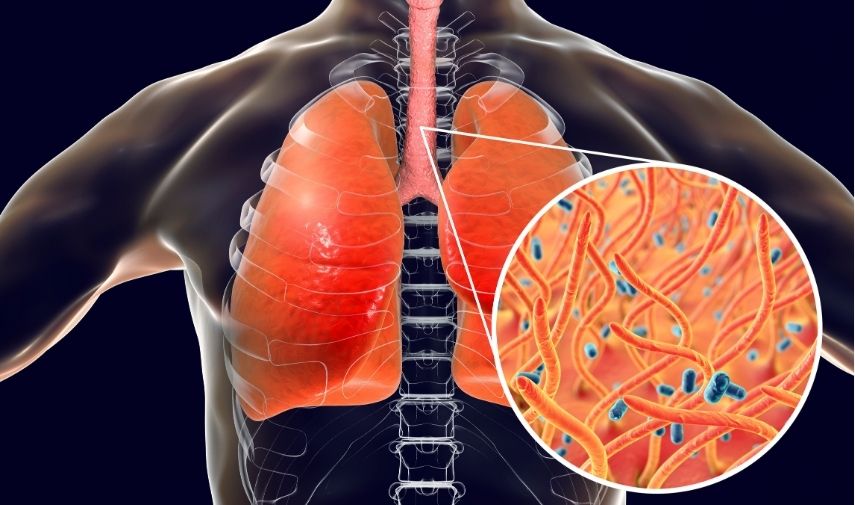 Tuberculosis
