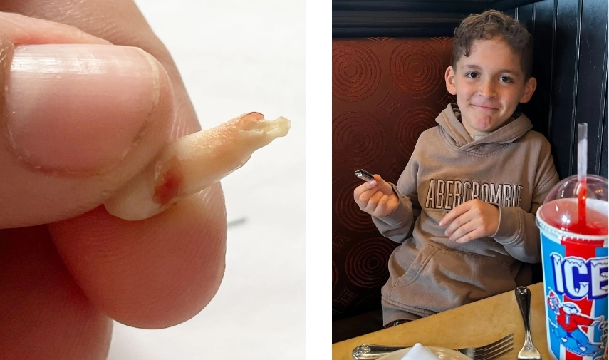 Crisis de salud dental infantil: más niños llegan a emergencias por falta de dentistas