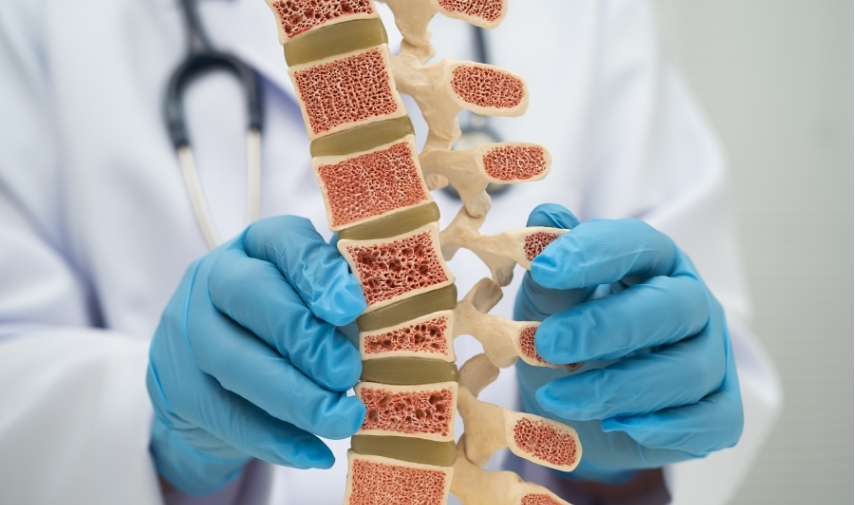 Qué es la osteoporosis, cuáles son sus principales causas y los riesgos que representa para la salud ósea,